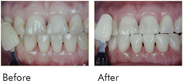 Teeth Whitening Before After Case 05