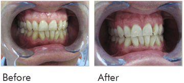 Teeth Whitening Before After Case 06