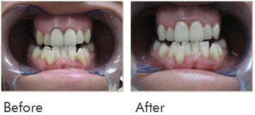 Crowns Before After Case 01