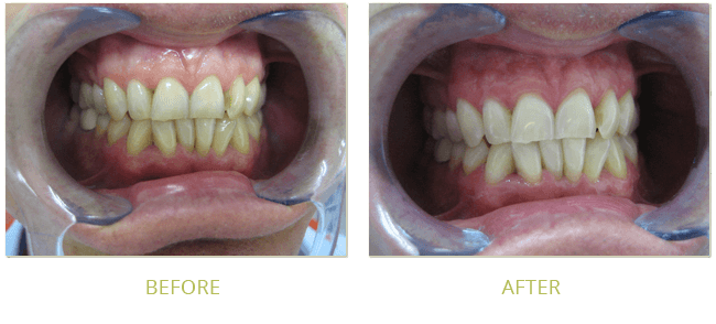 Smile Gallery Before After 13