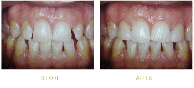 Smile Gallery Before After 06
