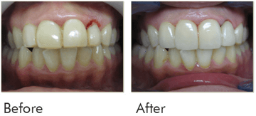 Crowns With Gum Contouring Before After Case 01