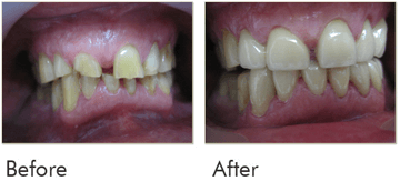 Crowns With Gum Contouring Before and After 01