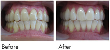 Teeth Whitening Before After Case 02