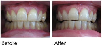 Teeth Whitening Before After Case 01