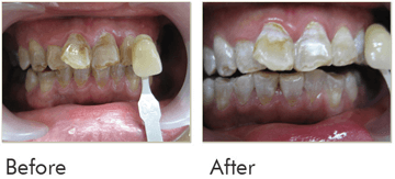 Teeth Whitening Before After Case 08