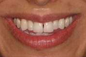 Before Treatment Image 03