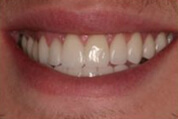 Porcelain Restorations Image 01