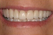 Porcelain Restorations Image 02