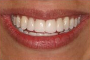 Porcelain Restorations Image 03
