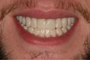 Provisional Restorations Image 01