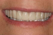 Provisional Restorations Image 02