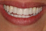 Provisional Restorations Image 03