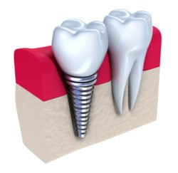 Dental implant
