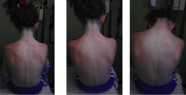 Before after treatment