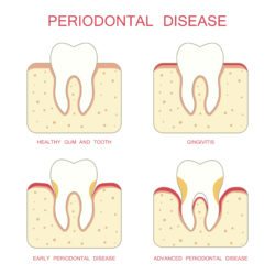Periodontal Disease