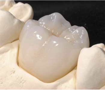 Full coverage porcelain crown Full coverage porcelain crown