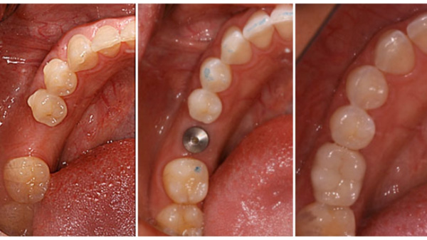 Dental implant