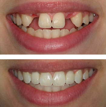 Dental implant Before After