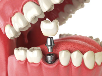 Dental implant illustration