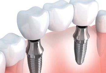 Dental implant illustration 1