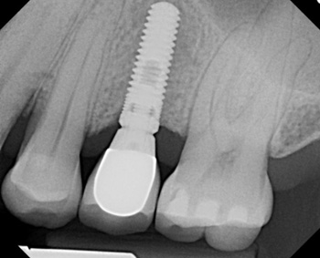 Dental implant x-ray