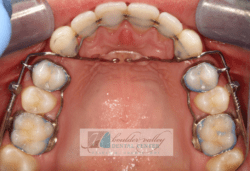 orthodontic braces