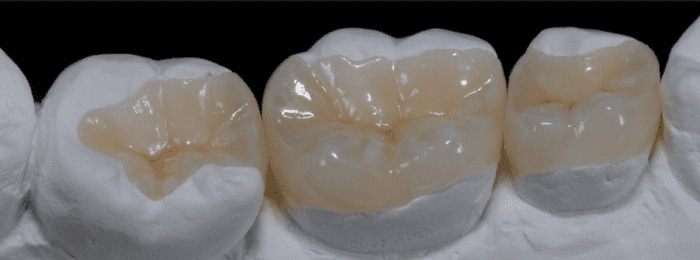 More conservative custom designed porcelain restorations conserve healthy tooth structure. More conservative custom designed porcelain restorations conserve healthy tooth structure.