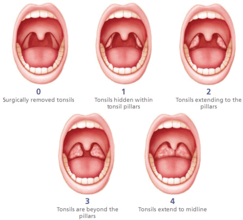 Surgically removed tonsils