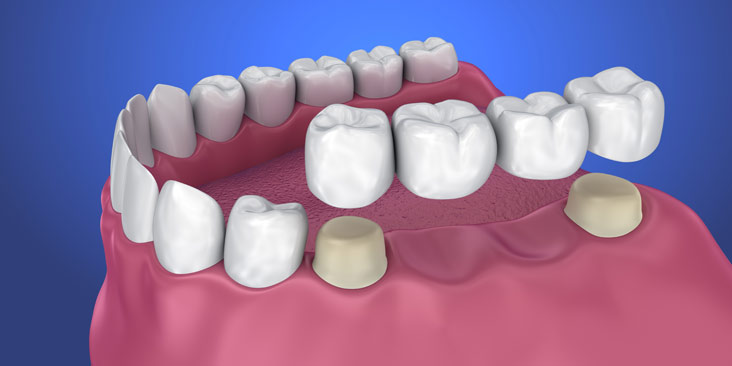 3D illustration of Dental Bridges