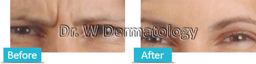 Botox Before and After