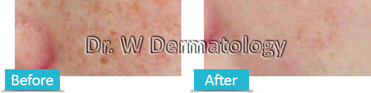 Freckles Before and After