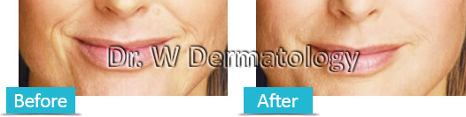 Juvederm Before and After