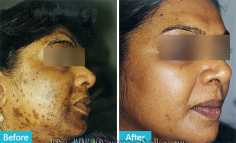 HYPERPIGMENTATION  Before After 01