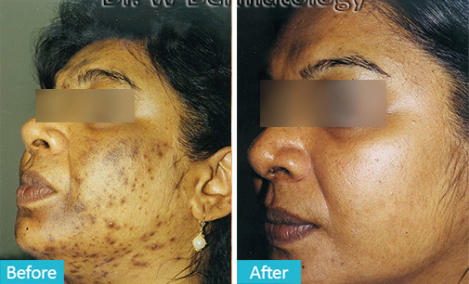 HYPERPIGMENTATION  Before After 02