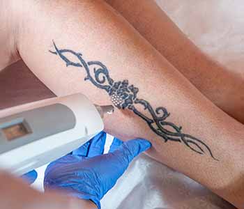 Dermatologist in the 77450 zip code describes laser tattoo removal