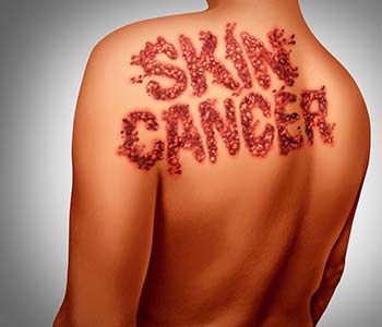 Addressing the causes of skin cancer in our Katy, TX dermatology practice, keeps your skin as healthy as possible