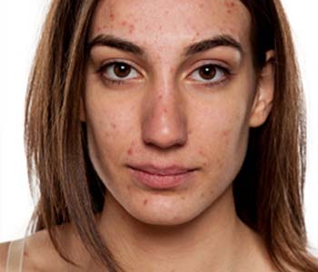 Houston area patients ask about chemical peels for acne