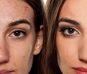 Katy dermatologist describes the effectiveness of blue light treatment