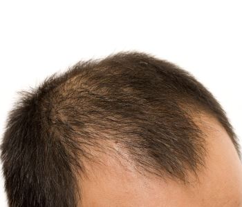 Diagnosing and treating hair loss in Katy, TX