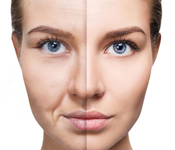 Katy TX area patients enjoy a wrinkle-free look for up to a year with Juvederm