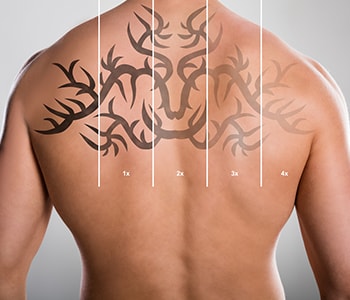 Clear your skin with the laser tattoo removal process in the Cinco Ranch area of Katy, Texas