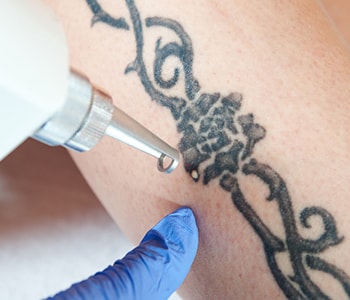 Tattoo regret? Dr. W Dermatology in the Houston – Katy area can help with laser tattoo removal