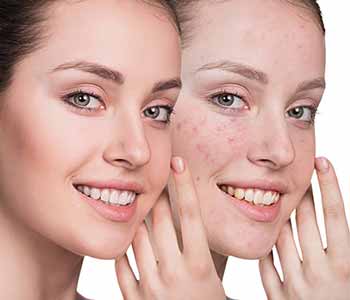 Houston, TX dermatologist describes the microdermabrasion procedure
