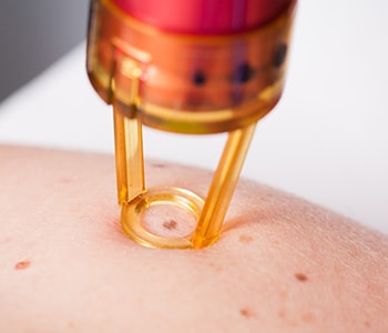 Reasons to choose a mole removal procedure in Katy, TX