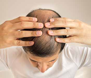 Houston area doctor offers PRP for hair loss