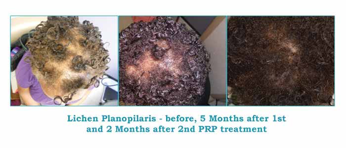 reverses effects of hair loss with proven PRP therapy