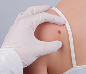 Removing moles in Katy, TX and beyond