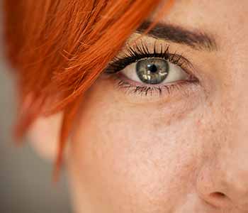 Are Katy patients with freckles at a higher risk for sunburn?