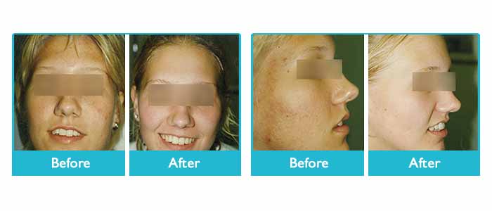 Before and After Microdermabrasion